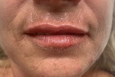 Lip Fillers Before & After Gallery - Patient 320267 - Image 2