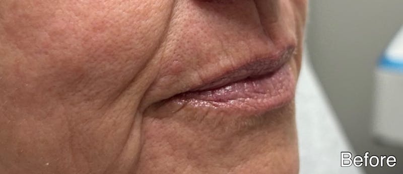 Lip Fillers Before & After Gallery - Patient 346173 - Image 5