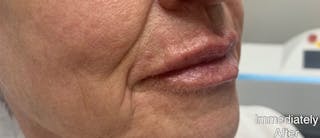 Lip Fillers Before & After Gallery - Patient 346173 - Image 6