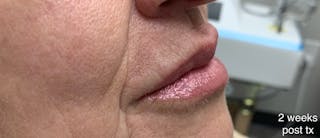 Lip Fillers Before & After Gallery - Patient 346173 - Image 8