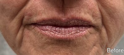 Lip Fillers Before & After Gallery - Patient 346173 - Image 1