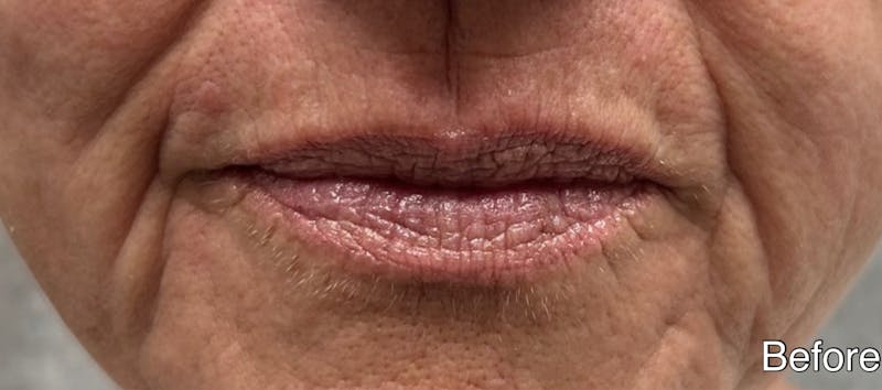 Lip Fillers Before & After Gallery - Patient 346173 - Image 1