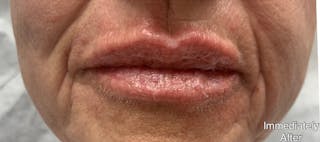 Lip Fillers Before & After Gallery - Patient 346173 - Image 2