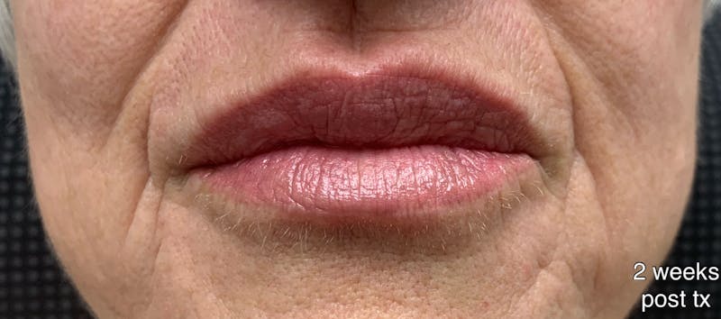 Lip Fillers Before & After Gallery - Patient 346173 - Image 4