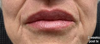 Lip Fillers Before & After Gallery - Patient 346173 - Image 4
