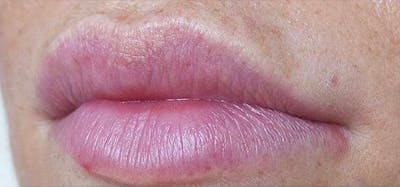 Lip Blushing Before & After Gallery - Patient 240170 - Image 1
