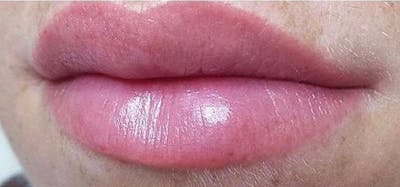 Lip Blushing Before & After Gallery - Patient 240170 - Image 2