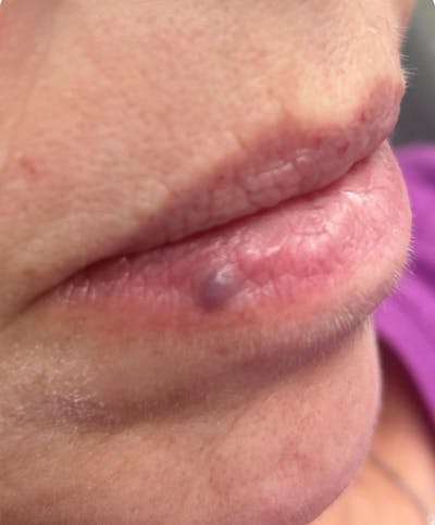 YAG Laser Before & After Gallery - Patient 395902 - Image 1