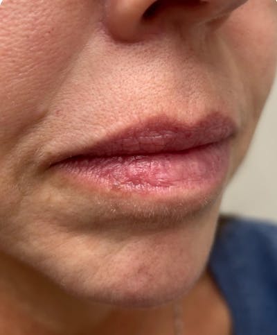 YAG Laser Before & After Gallery - Patient 395902 - Image 2