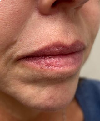 YAG Laser Before & After Gallery - Patient 395902 - Image 4