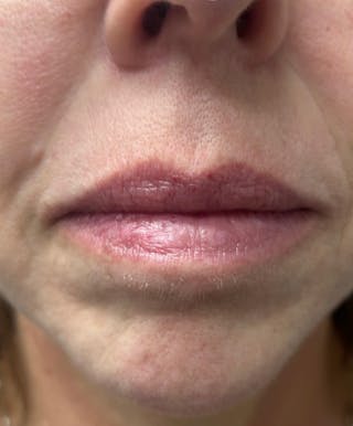YAG Laser Before & After Gallery - Patient 395902 - Image 6