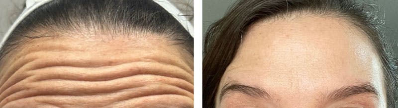 BOTOX Before & After Gallery - Patient 195959138 - Image 1