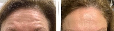 BOTOX Before & After Gallery - Patient 364467 - Image 1