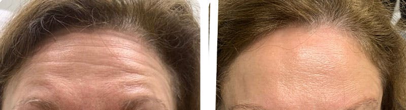 BOTOX Before & After Gallery - Patient 364467 - Image 1
