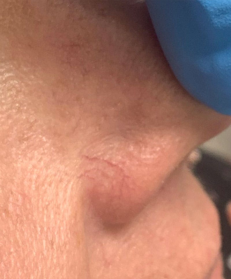 YAG Laser Before & After Gallery - Patient 296403 - Image 1