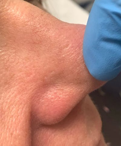 YAG Laser Before & After Gallery - Patient 296403 - Image 2