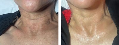 ZO Chemical Peel Before & After Gallery - Patient 322828 - Image 1