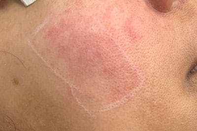 IPL Before & After Gallery - Patient 119173 - Image 1