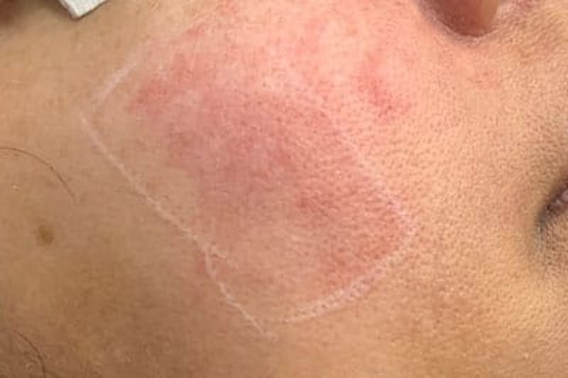 IPL Before & After Gallery - Patient 119173 - Image 1