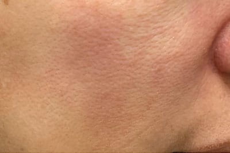 IPL Before & After Gallery - Patient 119173 - Image 2