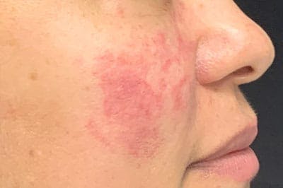 IPL Before & After Gallery - Patient 376894 - Image 1