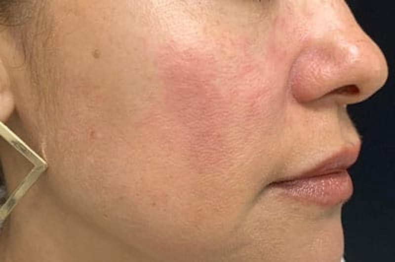 IPL Before & After Gallery - Patient 376894 - Image 2