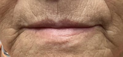 Lip Blushing Before & After Gallery - Patient 105079 - Image 1