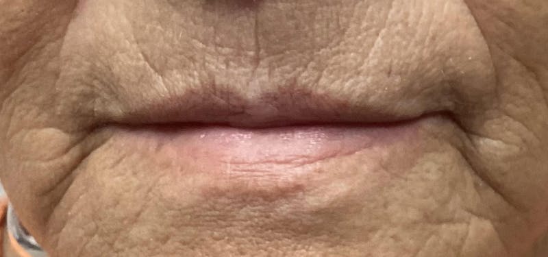 Lip Blushing Before & After Gallery - Patient 105079 - Image 1