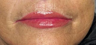 Lip Blushing Before & After Gallery - Patient 105079 - Image 2