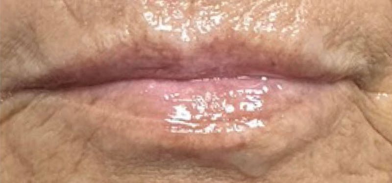 Lip Blushing Before & After Gallery - Patient 105079 - Image 3