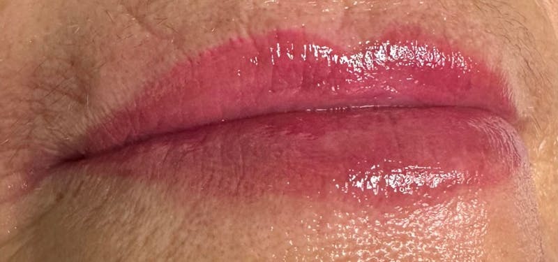 Lip Blushing Before & After Gallery - Patient 105079 - Image 4