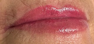 Lip Blushing Before & After Gallery - Patient 105079 - Image 4