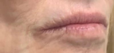 Lip Blushing Before & After Gallery - Patient 241538 - Image 1