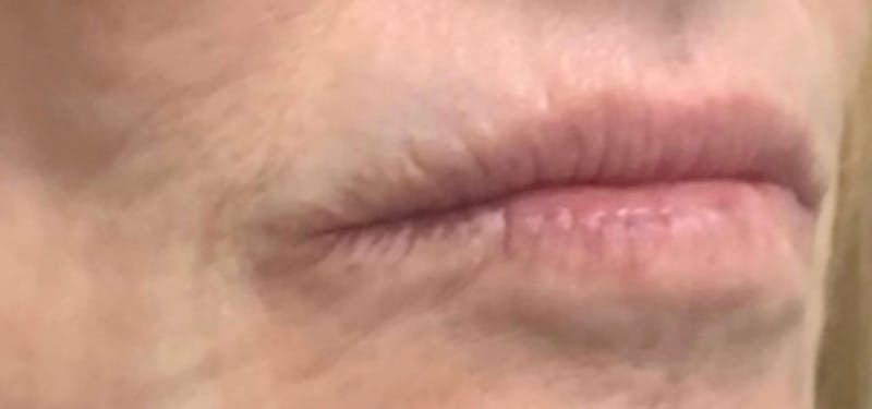 Lip Blushing Before & After Gallery - Patient 241538 - Image 1