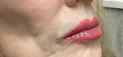 Lip Blushing Before & After Gallery - Patient 241538 - Image 2