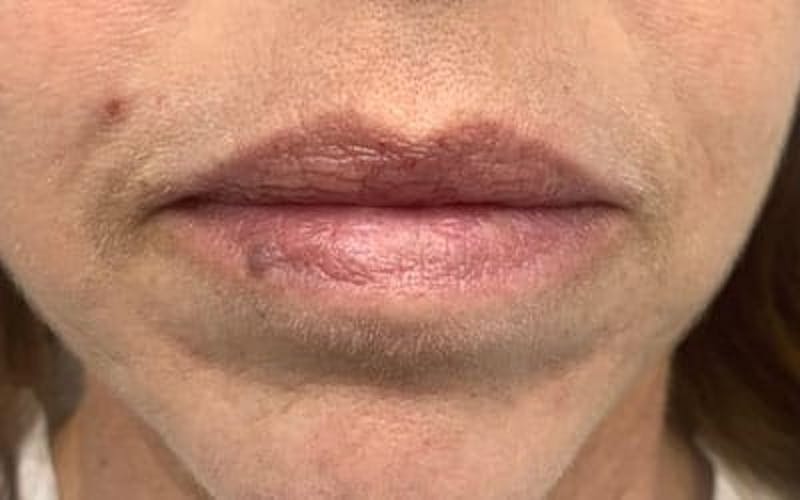 YAG Laser Before & After Gallery - Patient 228216 - Image 1