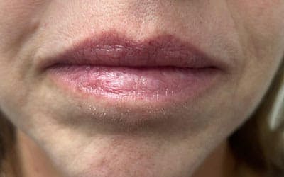 YAG Laser Before & After Gallery - Patient 228216 - Image 2