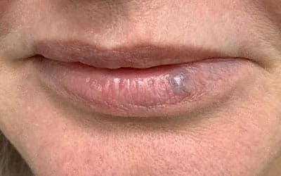 YAG Laser Before & After Gallery - Patient 803667 - Image 1