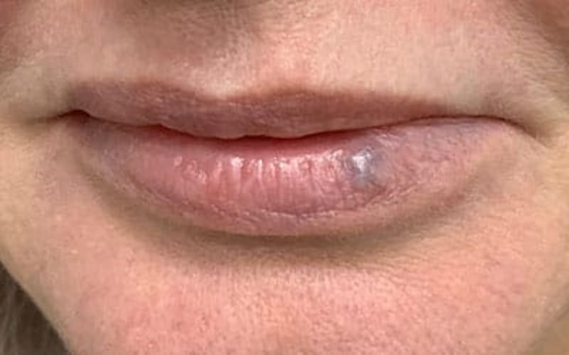 YAG Laser Before & After Gallery - Patient 803667 - Image 1