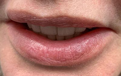 YAG Laser Before & After Gallery - Patient 803667 - Image 2