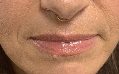 Lip Flip Before & After Gallery - Patient 116141 - Image 1