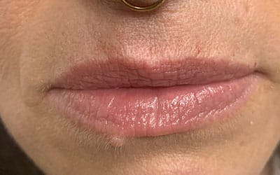 Lip Flip Before & After Gallery - Patient 116141 - Image 2