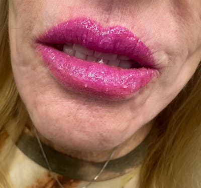 Lip Blushing Before & After Gallery - Patient 805397 - Image 2