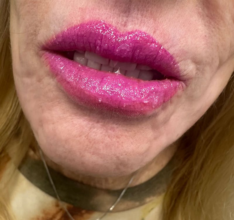 Lip Blushing Before & After Gallery - Patient 805397 - Image 2
