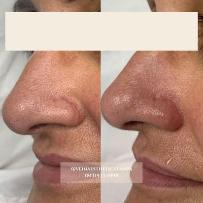 YAG Laser Before & After Gallery - Patient 208718 - Image 1