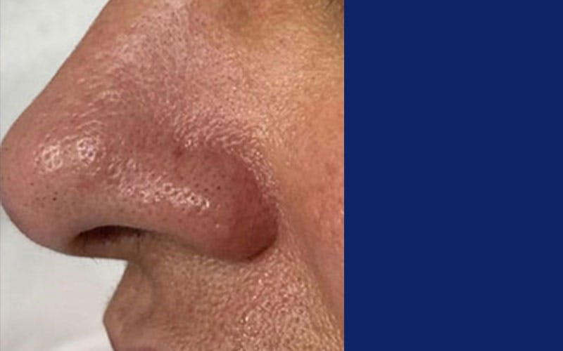 Before & After YAG Laser
