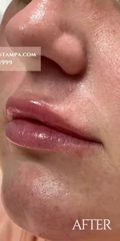 Lip Fillers Before & After Gallery - Patient 129010 - Image 2
