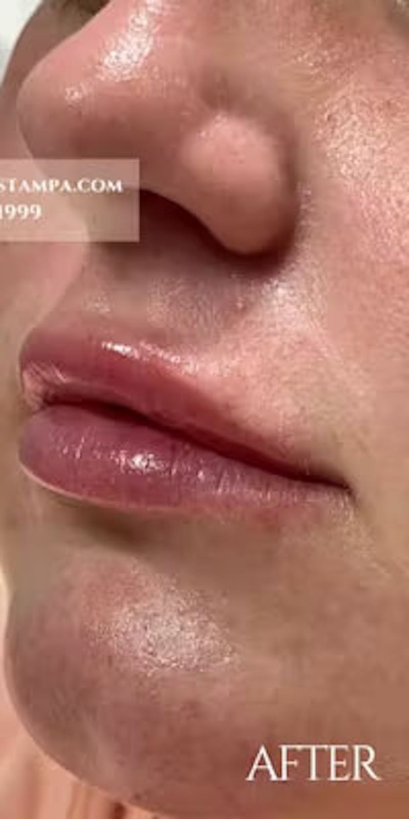 Lip Fillers Before & After Gallery - Patient 129010 - Image 2