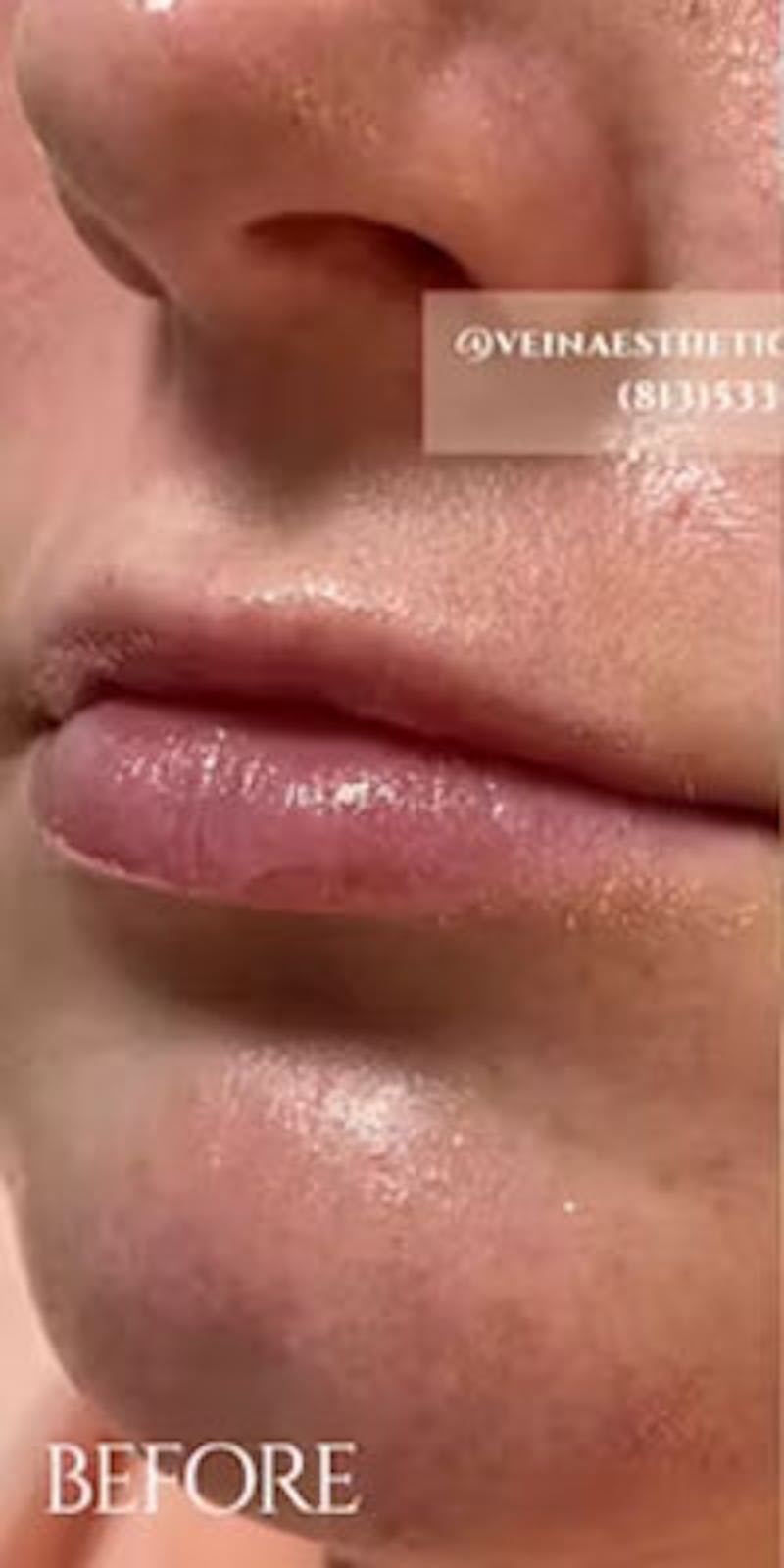 Lip Fillers Before & After Gallery - Patient 129010 - Image 1