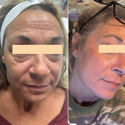UltraPulse Laser Before & After Gallery - Patient 321955 - Image 1